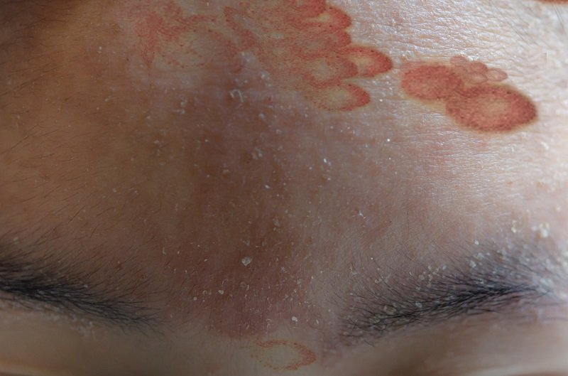 Psoriasis im Gesicht erfolgreich behandeln