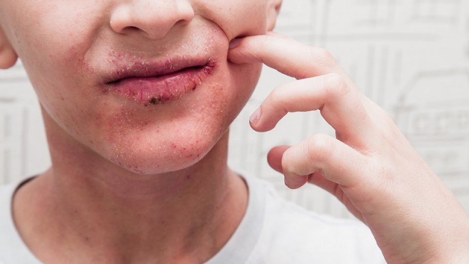 Bild zum Artikel Psoriasis im Gesicht
