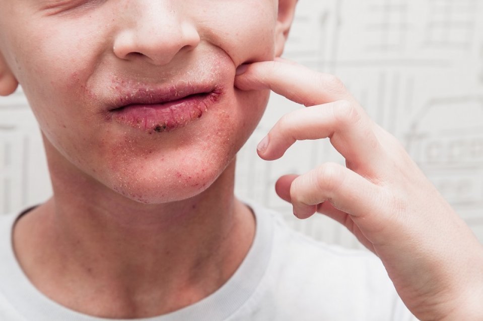 Bild zum Artikel Psoriasis im Gesicht