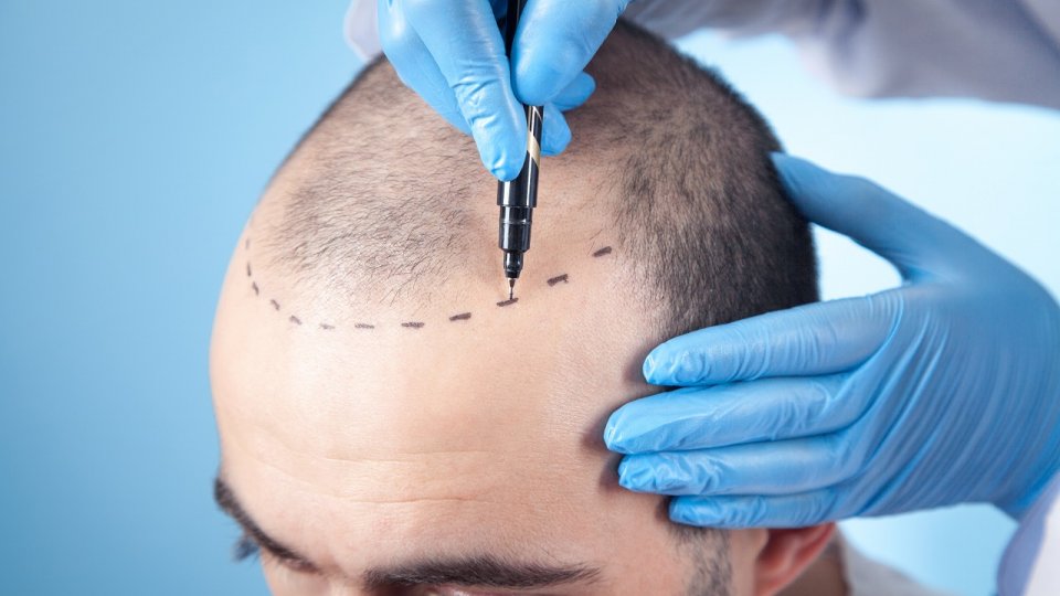 Bild zum Artikel Beste Haartransplantation Türkei