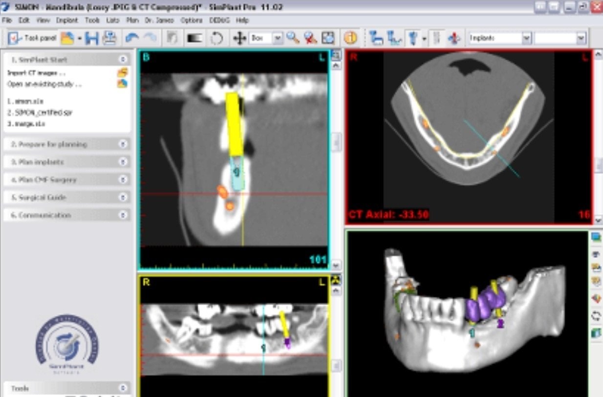 3D-Implantatplanung als Herzstück der minimalinvasiven Behandlungsmethoden