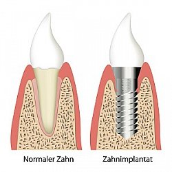 Mit Implantaten einen Zahn ersetzen