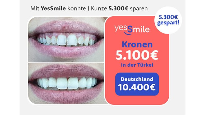 Zähne in der Türkei machen lassen bei YesSmile