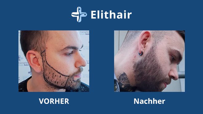 Barthaartransplantation Türkei Kosten