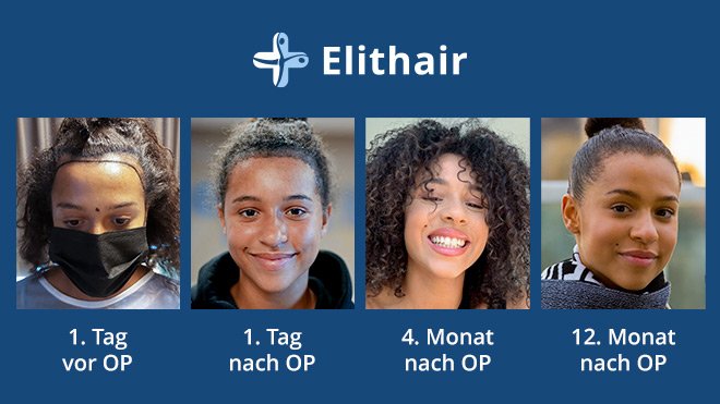 Haartransplantation Vorher-Nachher: Top-Resultate