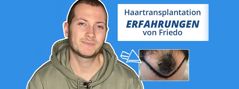 Haartransplantation Erfahrung Elithair