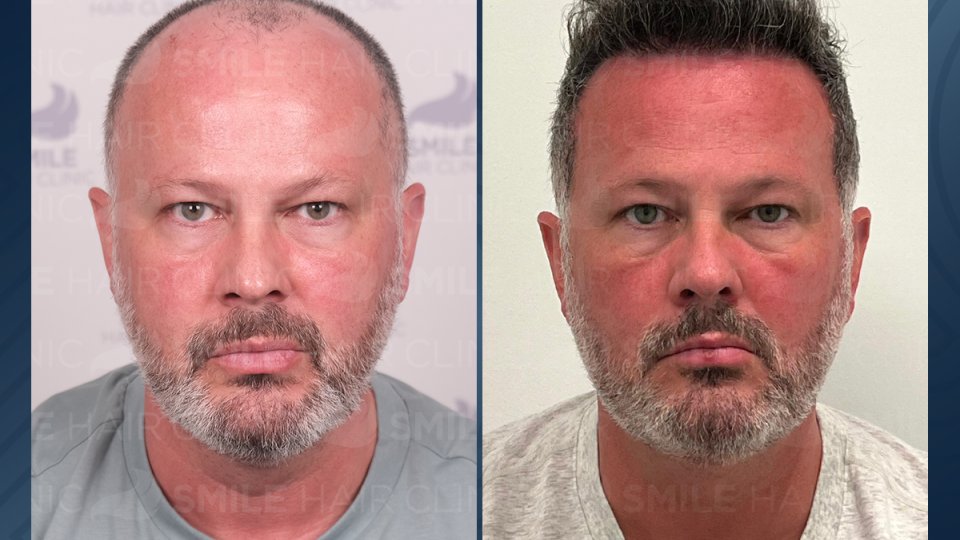 Bild zum Artikel Haartransplantation Türkei Preise