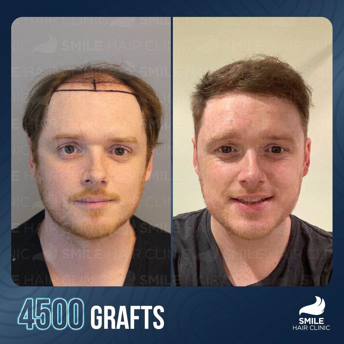 Haartransplantation in der Türkei Preise